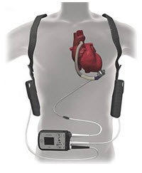 Image shows the components of a Left Ventricular Assist Device (LVAD) implanted in the body and the monitoring system and batteries the patient carries outside of their bodies